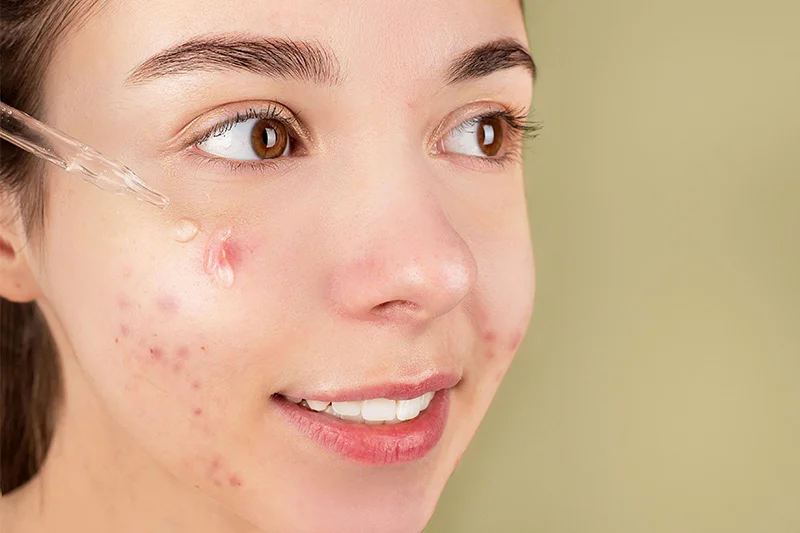 Acne Facial