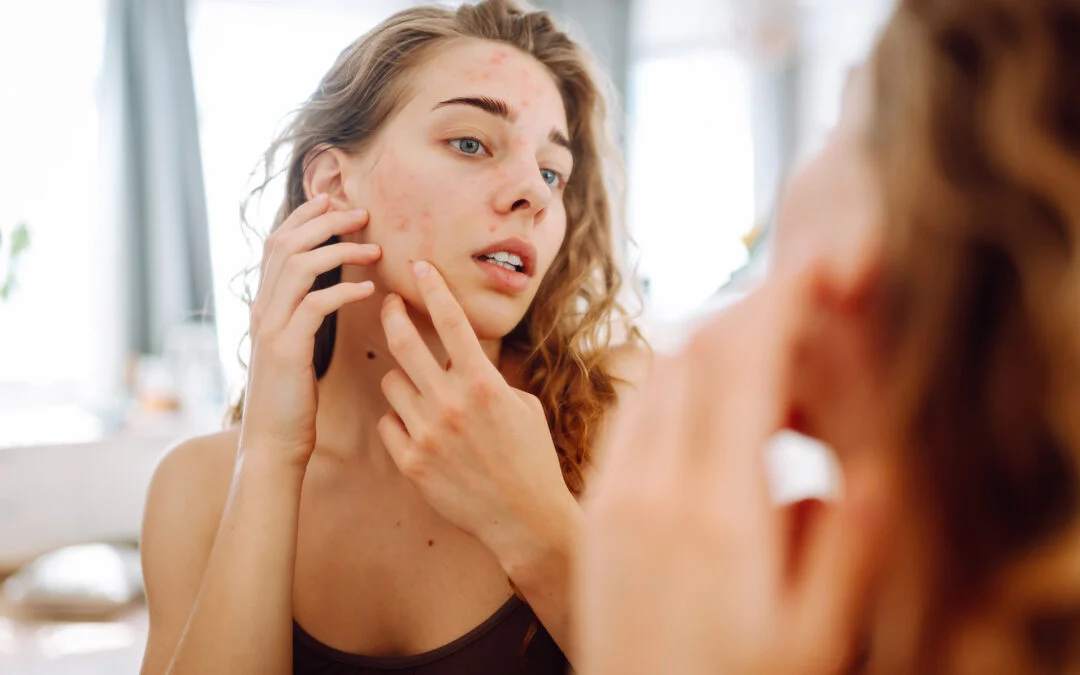 Effective Acne Management: A Guide to Clear, Healthy Skin