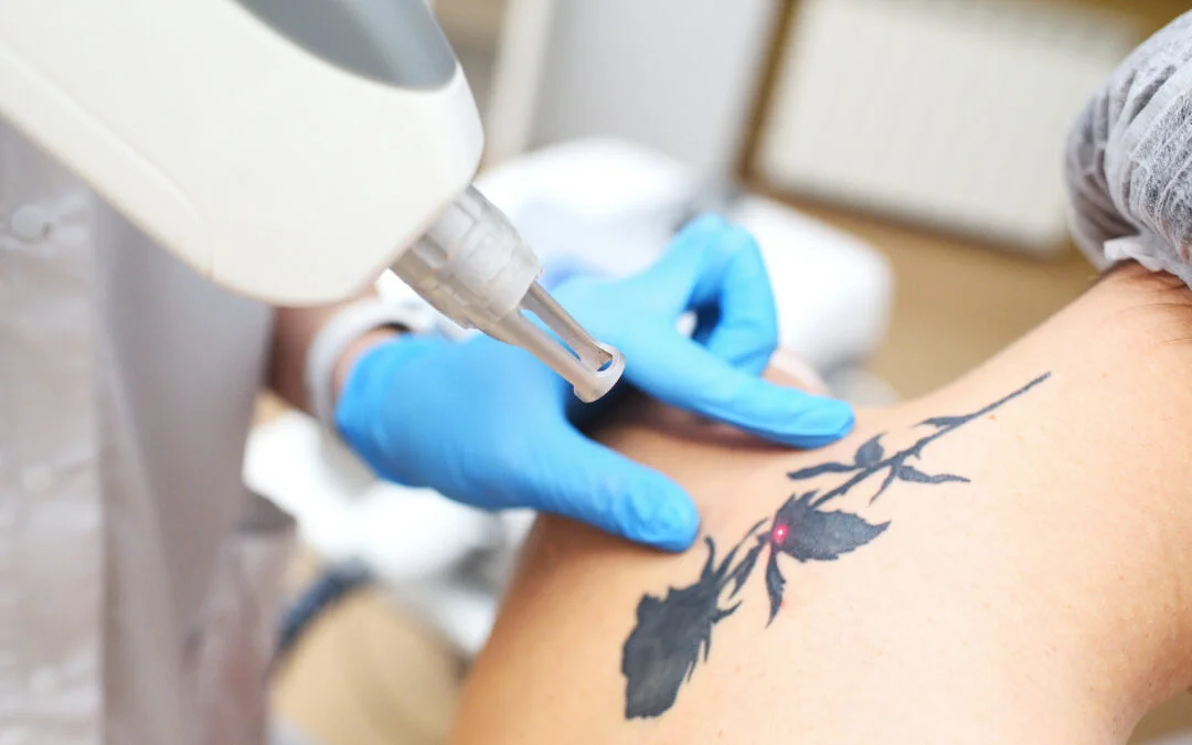 Tattoo Removal at Glow Aesthetics: A Fresh Start with Advanced Laser Technology