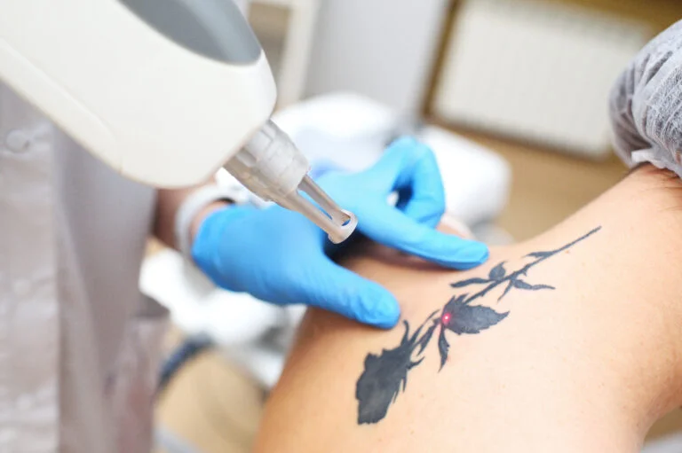 Tattoo Removal at Glow Aesthetics: A Fresh Start with Advanced Laser Technology