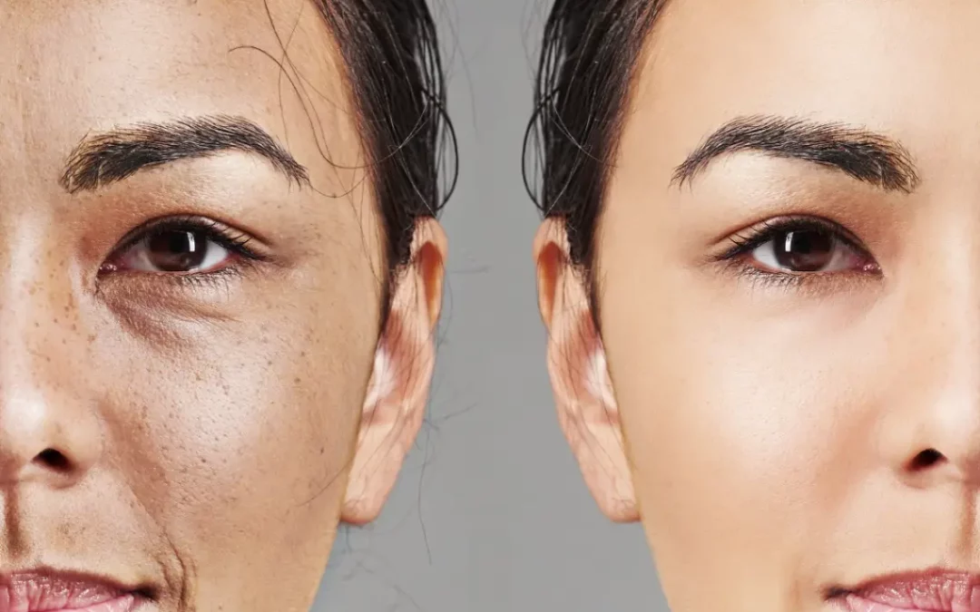 An Overview of VI Peel Treatments at Glow Aesthetics