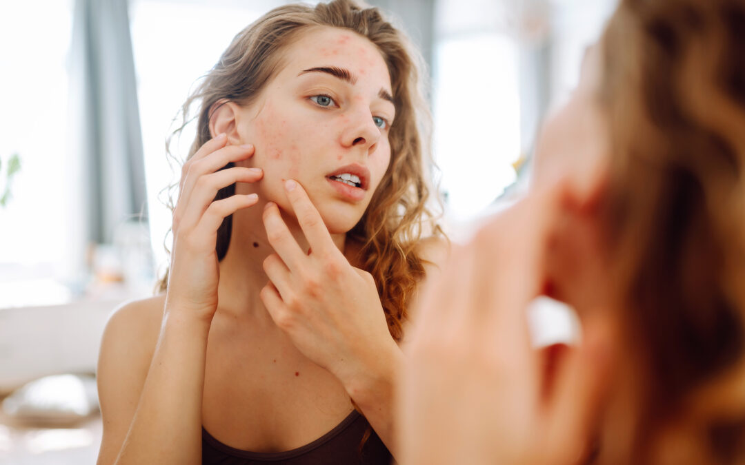 Effective Acne Management: A Guide to Clear, Healthy Skin